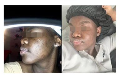 Glow Cream,Hyperpigmentation Cream, Acne Cream - Laaleeglow 