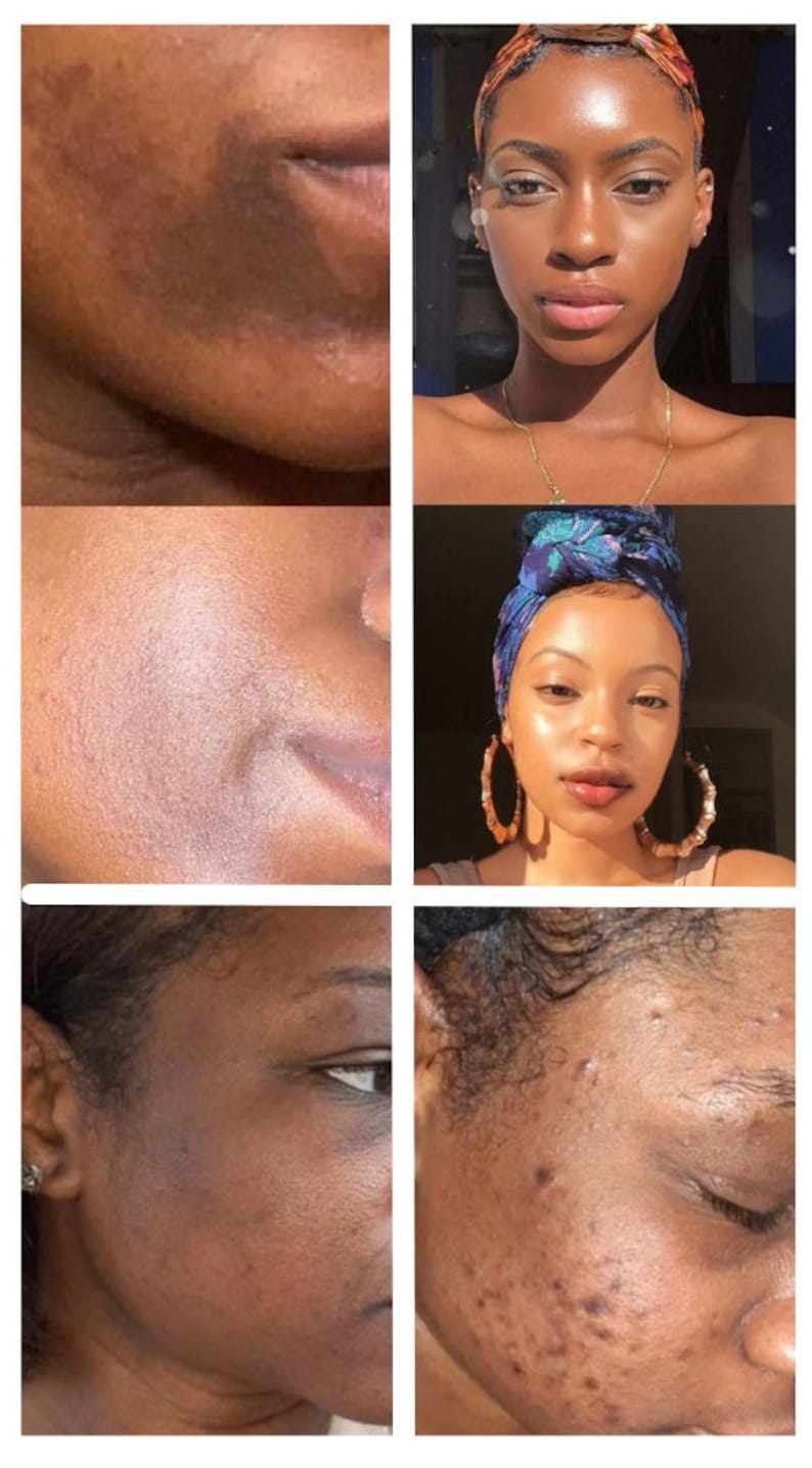 Turmeric Honey Carrot Scrub, Exfoliate Scrub, Hyperpigmentation Scrub, Foaming Scrub - Laaleeglow 